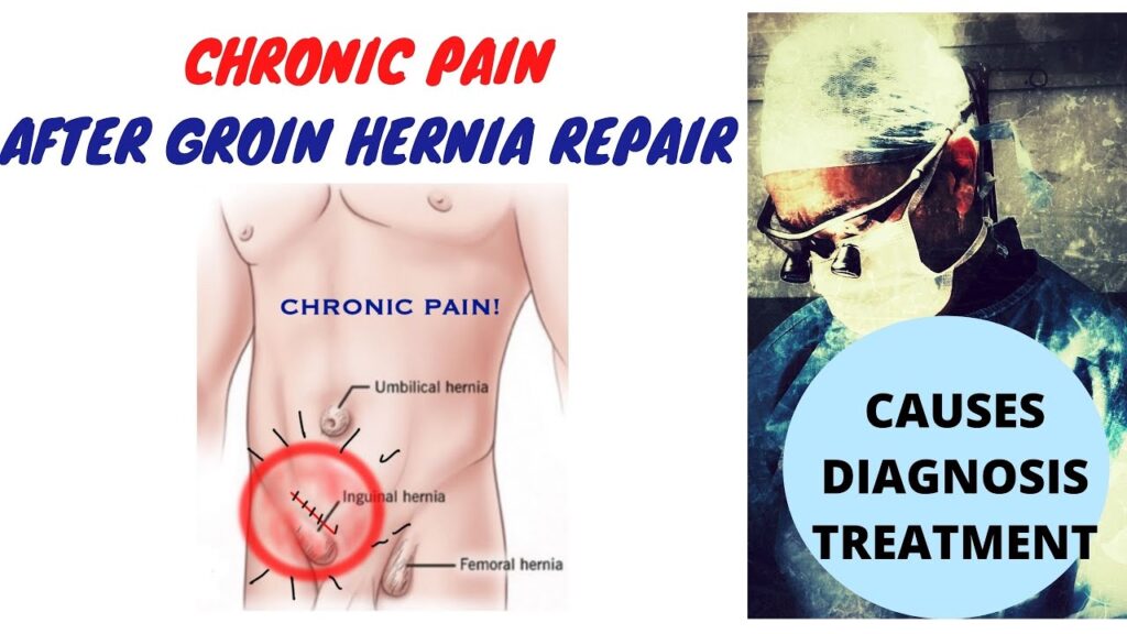 Hernia Repair Auckland: Recovery Tips for Faster Healing